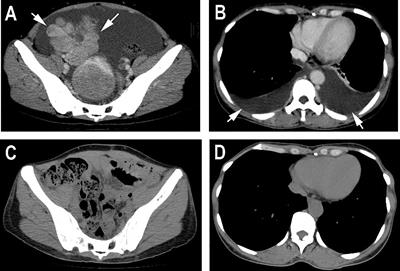 Pseudo-Meigs’ syndrome secondary to breast cancer with ovarian metastasis: a case report and literature review